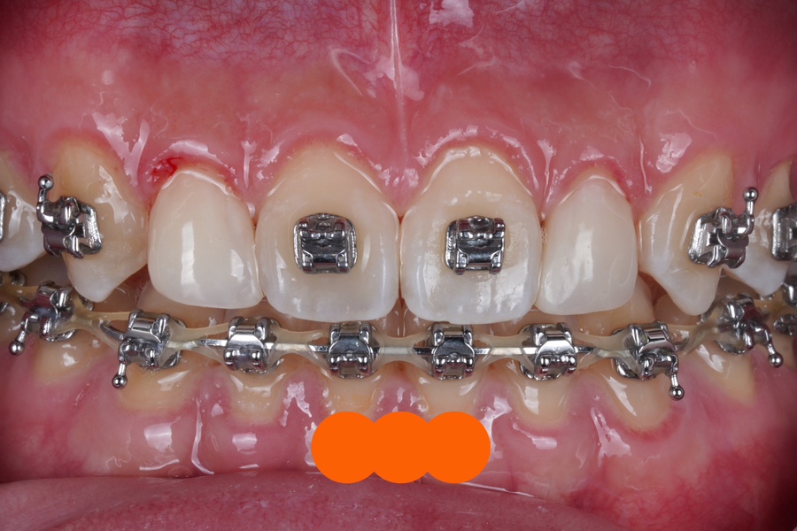 왜소치 레진 비니어, 교정 마무리 할 때 오시면 참 좋습니다. 관련 이미지 3