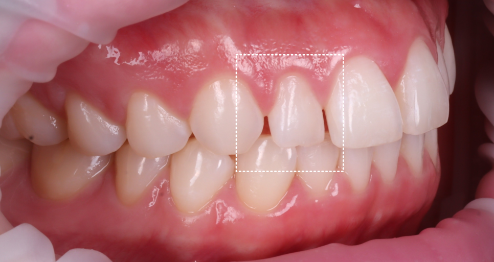 If Your Front Teeth Look Extra Large, Be Sure to Read This — Gyodae Station Dental Clinic image 3