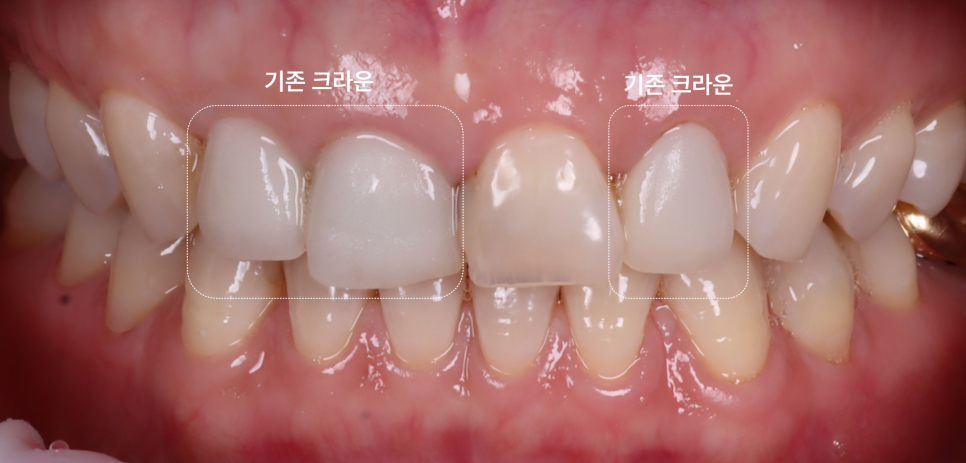 라미네이트, 크라운 재치료, 잇몸 성형까지 앞니 6개 치료 관련 이미지 2