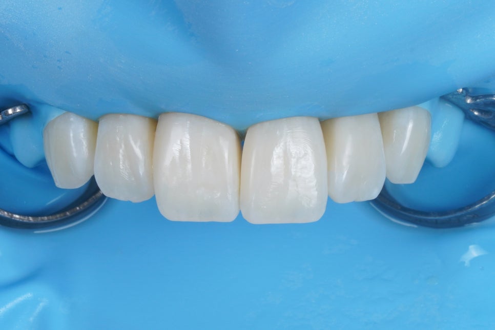 블랙 트라이앵글 (블트) 레진으로 건강하게 치료하는 방법 관련 이미지 5