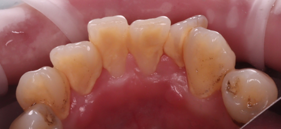 서초동치과 착색 고민되면 에어플로우 하세요 관련 이미지 5