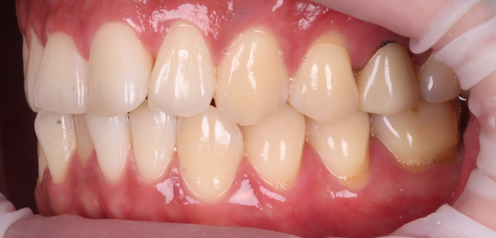 Do Cavities Between Teeth at Sinsa Station Dental Clinic Have to Be Treated with an Inlay? Resin Is Also an Option image 3