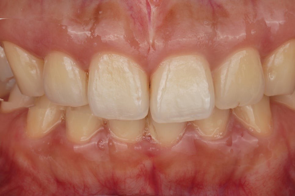 앞니 벌어짐을 레진 비니어로 당일 치료한 서초동 치과 관련 이미지 3