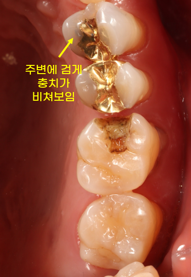 교대치과 신경치료 후 크라운 안 하고 오버레이로 보존 관련 이미지 2