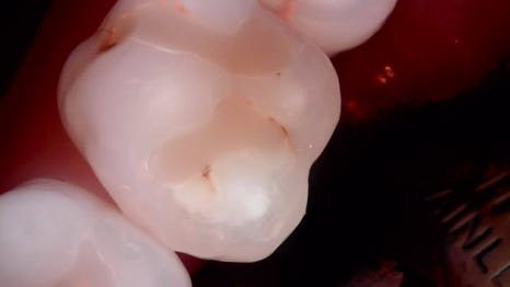 교대역 치과 보철 아래 2차 충치를 다시 레진으로 관련 이미지 10