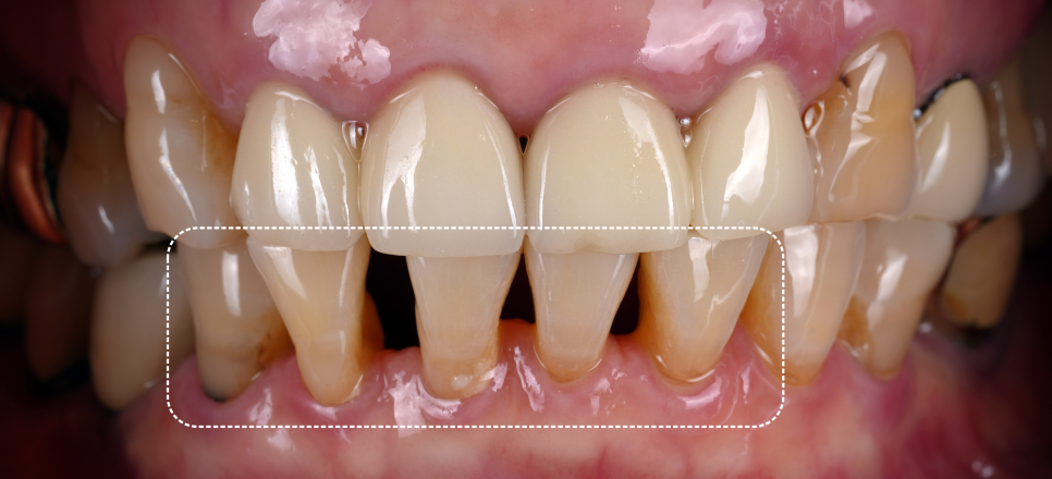 반포치과 70대 앞니 벌어짐 레진 당일 치료 케이스 관련 이미지 5
