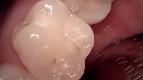 교대역 치과 보철 아래 2차 충치를 다시 레진으로 관련 이미지 9