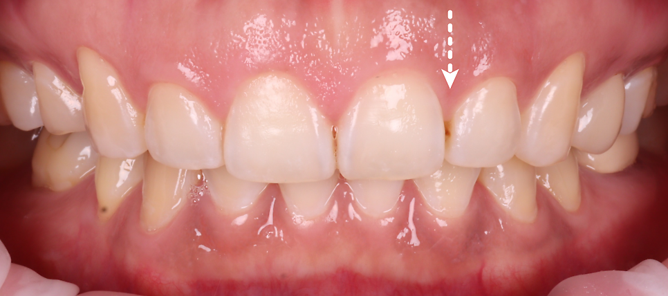 서초구치과 치아 사이 삭제 부작용과 치료법 관련 이미지 6