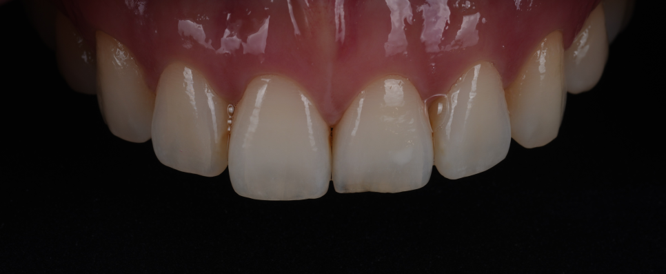 강남치과 짧아 보이는 치아 레진으로 당일 치료 관련 이미지 1