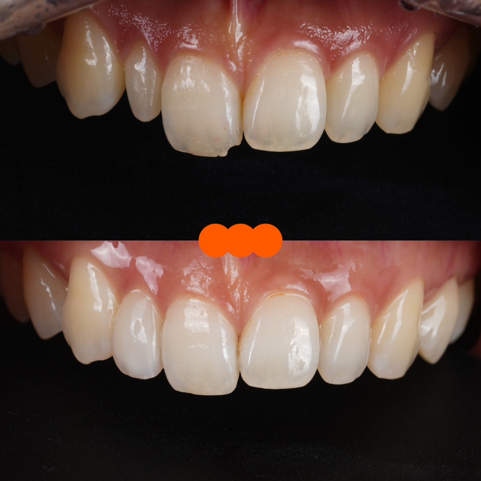 왜소치 라미네이트보다 레진 비니어를 더 추천드리는 이유 관련 이미지 6