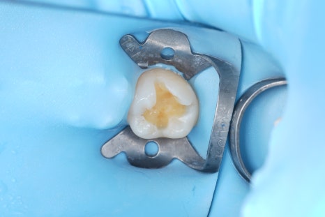 교대역치과 타치과 신경치료, 크라운 진단받았으나 레진으로 치료 관련 이미지 16