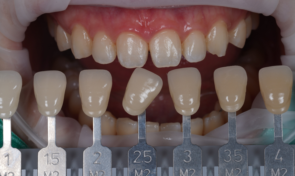 앞니 벌어짐 레진 비니어 후 미인대회 출전 관련 이미지 8
