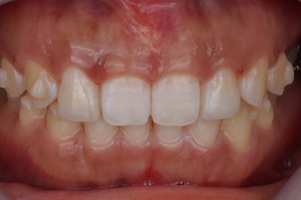 앞니 치료, 왜소치 레진은 교대역 치과에서 당일 치료받으세요 관련 이미지 5