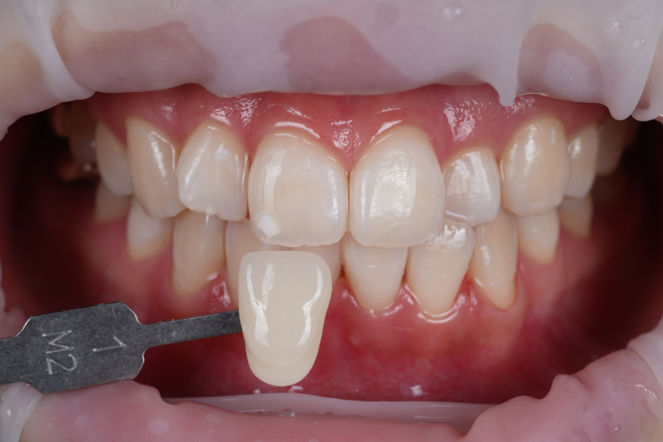 신논현치과 치아미백 누구나 예쁘게 하얗게 되는 건 아니다? 관련 이미지 6