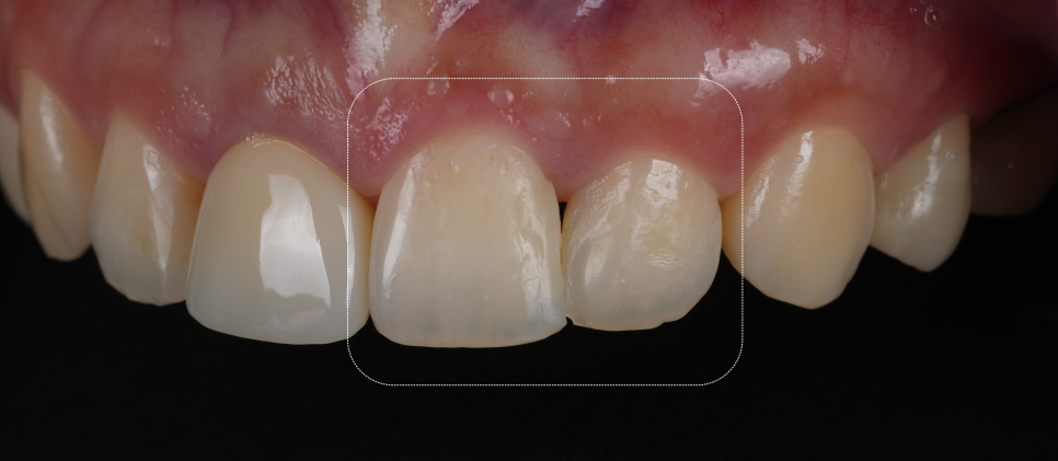 서초동치과 전라도 광주에서 레진 재치료 받으러 오신 사례 관련 이미지 2