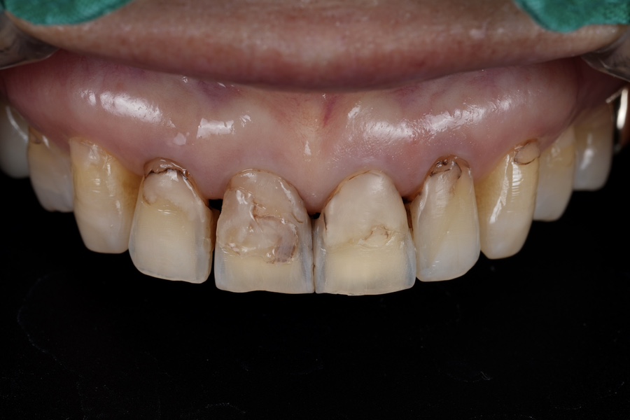 레진 변색 재치료, 다시 깨끗하게 만들어 볼까요? 관련 이미지 1