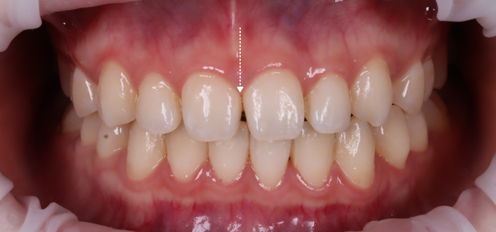 앞니 벌어짐 레진 비니어 후 미인대회 출전 관련 이미지 3