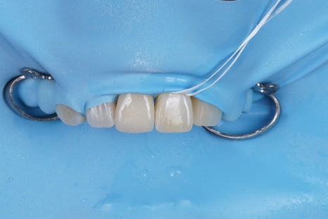 앞니 깨짐 레진 어디서할지 고민될 때 꼭 보세요 관련 이미지 7