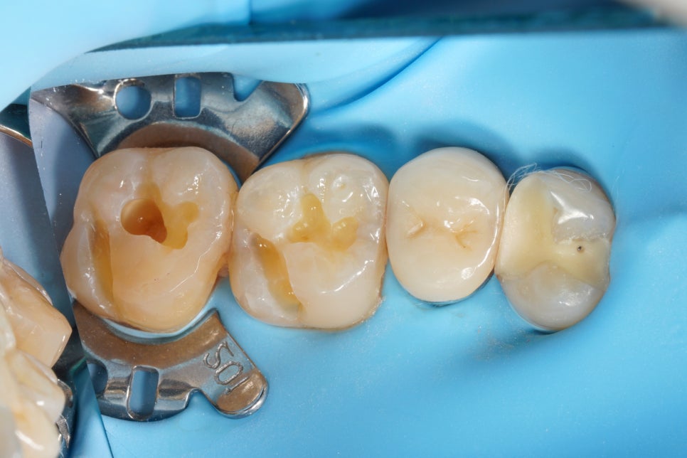교대역 레진 실란트 밑에 깊은 2차충치 레진빌드업으로 당일 재치료 관련 이미지 5