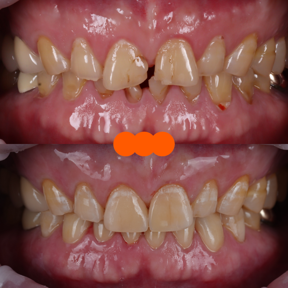 앞니 크라운 브릿지 재치료 시 이럴 땐 따로 제작해야 돼요 관련 이미지 5