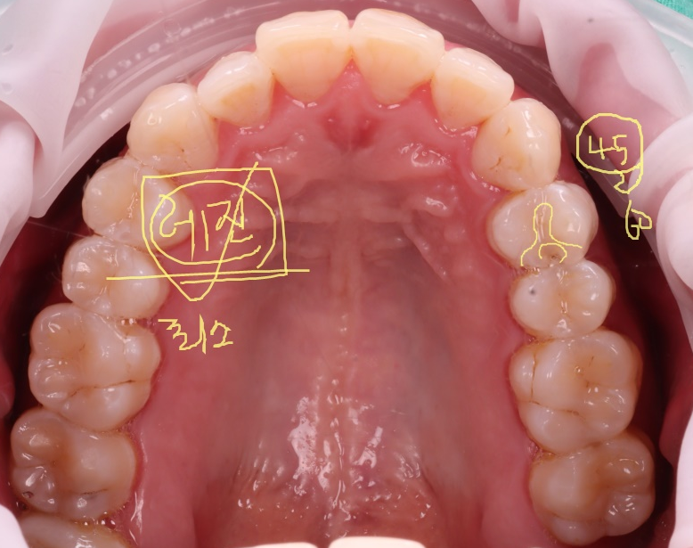 강남역치과 치료 부위 2차 충치 레진 재치료 사례 관련 이미지 7