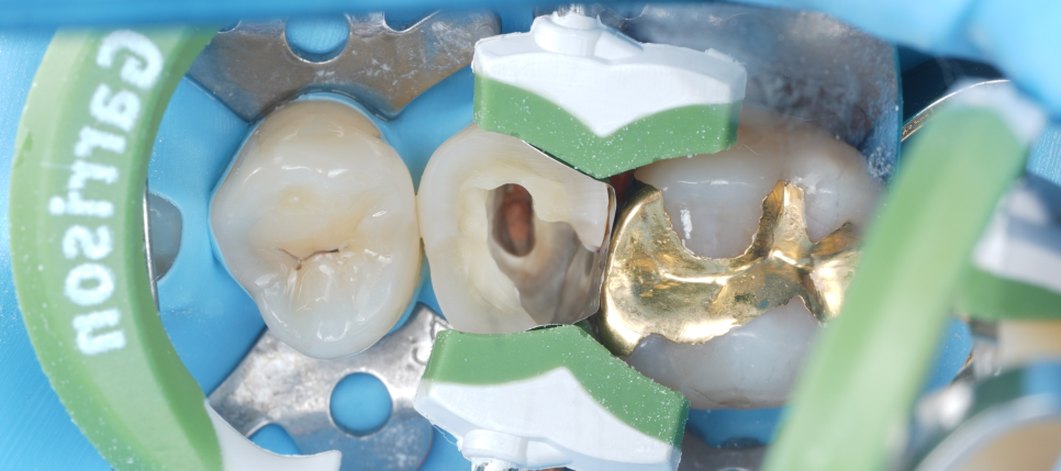 신경치료 후 크라운 안 하고 레진으로 할 수 있어요 관련 이미지 8