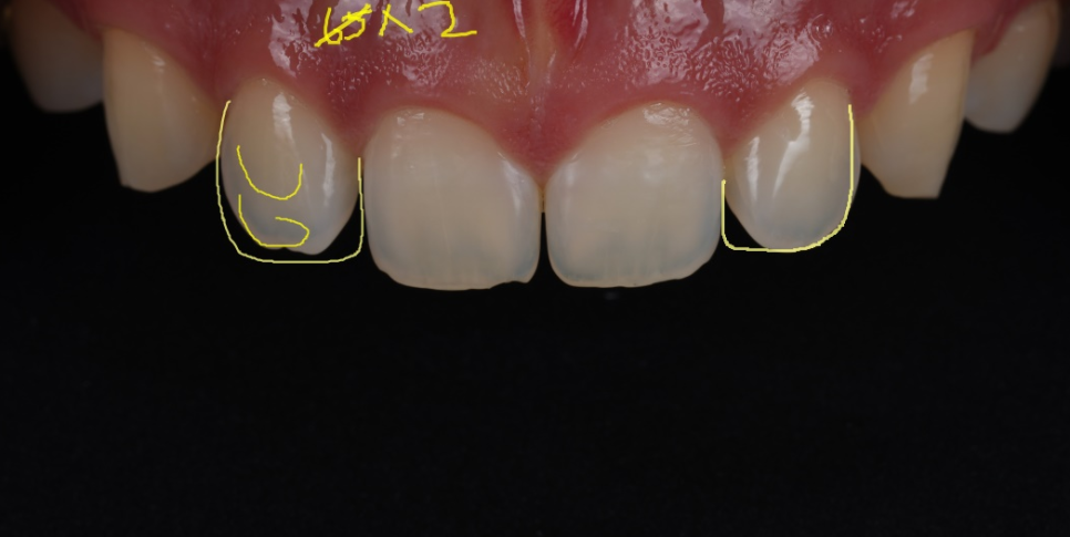 Apgujeong Dental Clinic: 3 Things Needed for Successful Resin Treatment of Peg Laterals image 7