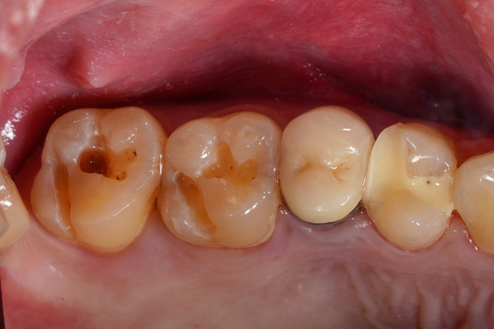 교대역 레진 실란트 밑에 깊은 2차충치 레진빌드업으로 당일 재치료 관련 이미지 4