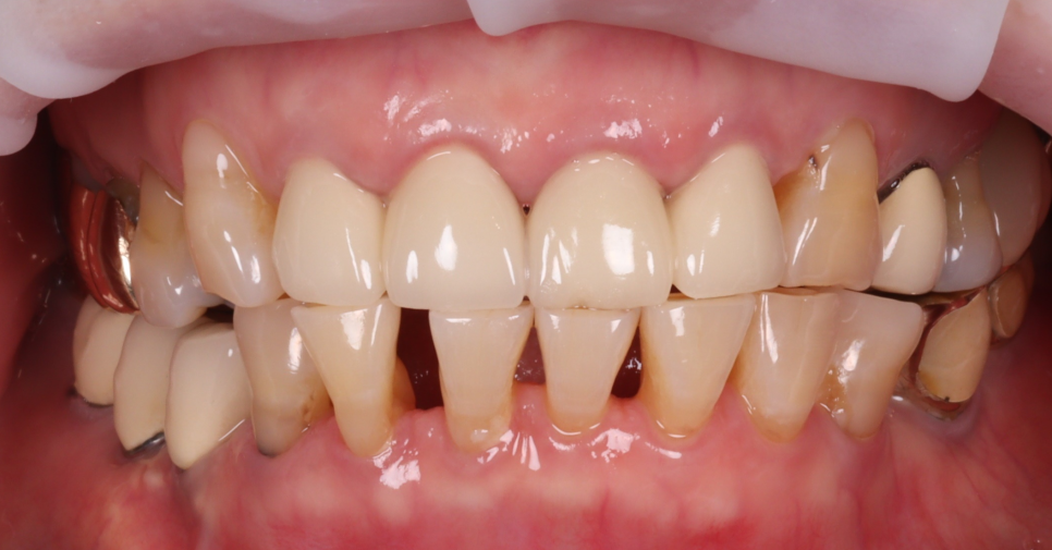 반포치과 70대 앞니 벌어짐 레진 당일 치료 케이스 관련 이미지 2