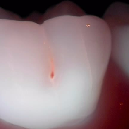 치과의사도 충치가 생기는 : 어금니 뺨쪽 구멍 충치 치료 관련 이미지 2