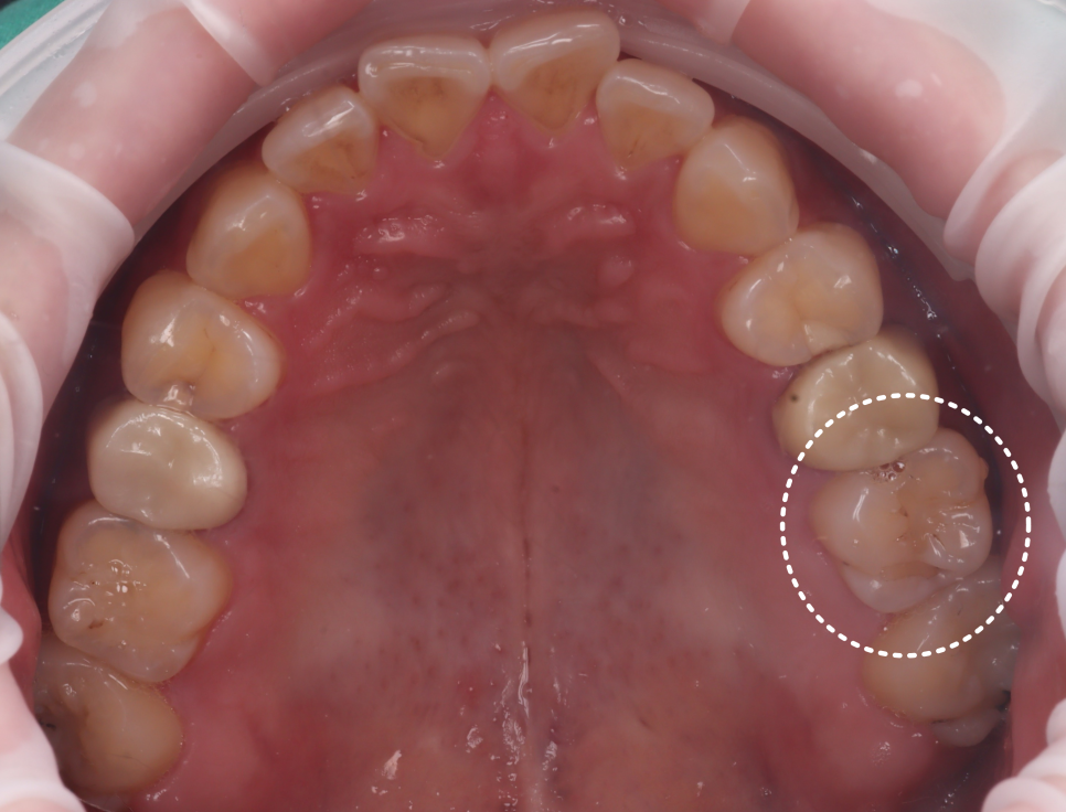 Do Cavities Between Teeth at Sinsa Station Dental Clinic Have to Be Treated with an Inlay? Resin Is Also an Option image 5