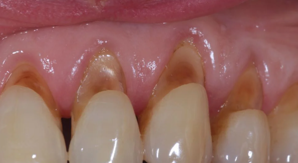 이갈이 장치 보톡스랑 함께 하면 훨씬 좋은 이유 관련 이미지 8