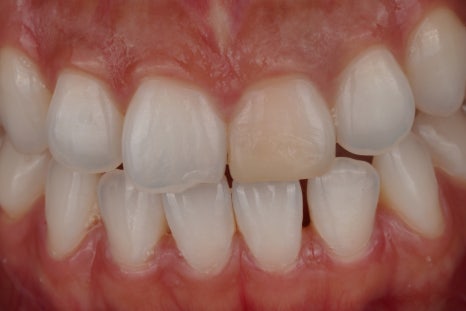 앞니 신경치료 변색 원인과 치료법인 실활치 미백 관련 이미지 6