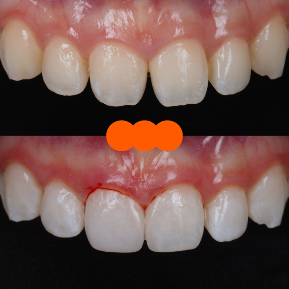 앞니 벌어짐 레진으로 삭제없이 충분히 예쁘게 할 수 있어요 관련 이미지 1