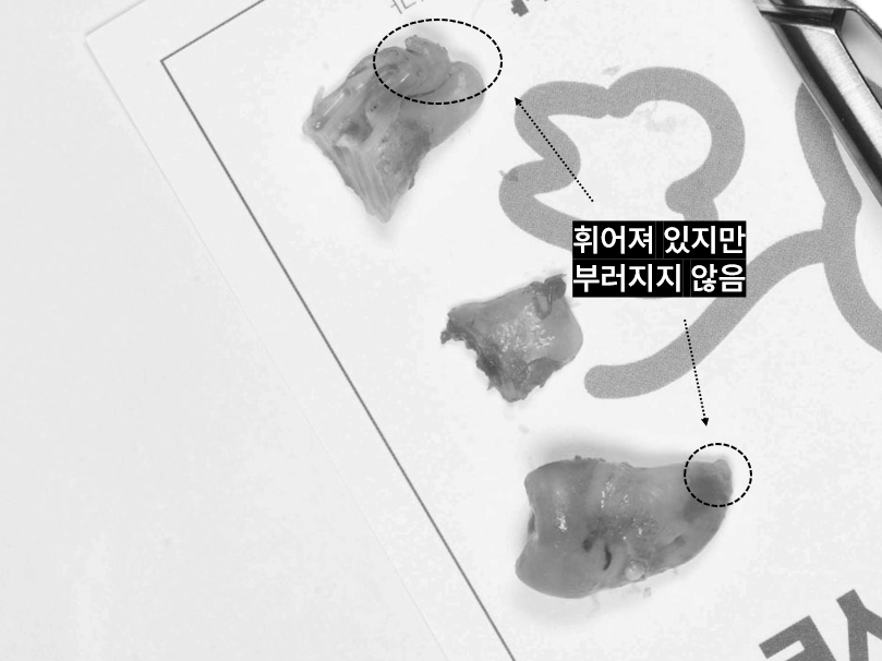 사랑니발치 매복 돼도 이렇게 빼면 안전해요 관련 이미지 14