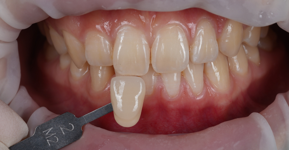 역삼역치과 벌어진 앞니 레진 이렇게 해야 진짜 티 안나요 관련 이미지 13