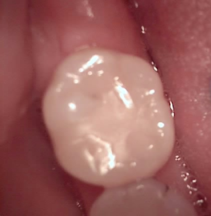 교대역 치과 보철 아래 2차 충치를 다시 레진으로 관련 이미지 19