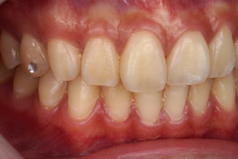 강남역 근처 치과, 투스젬 제거는 여기로 와야합니다 관련 이미지 3