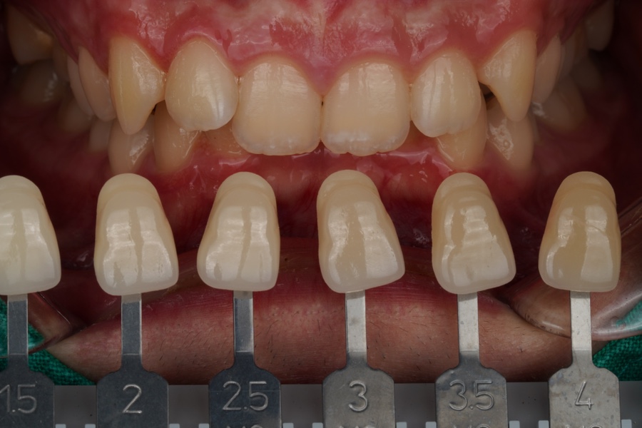 서초 원데이 치아미백은 교대역 재주좋은치과의원이 좋은 EU 관련 이미지 3