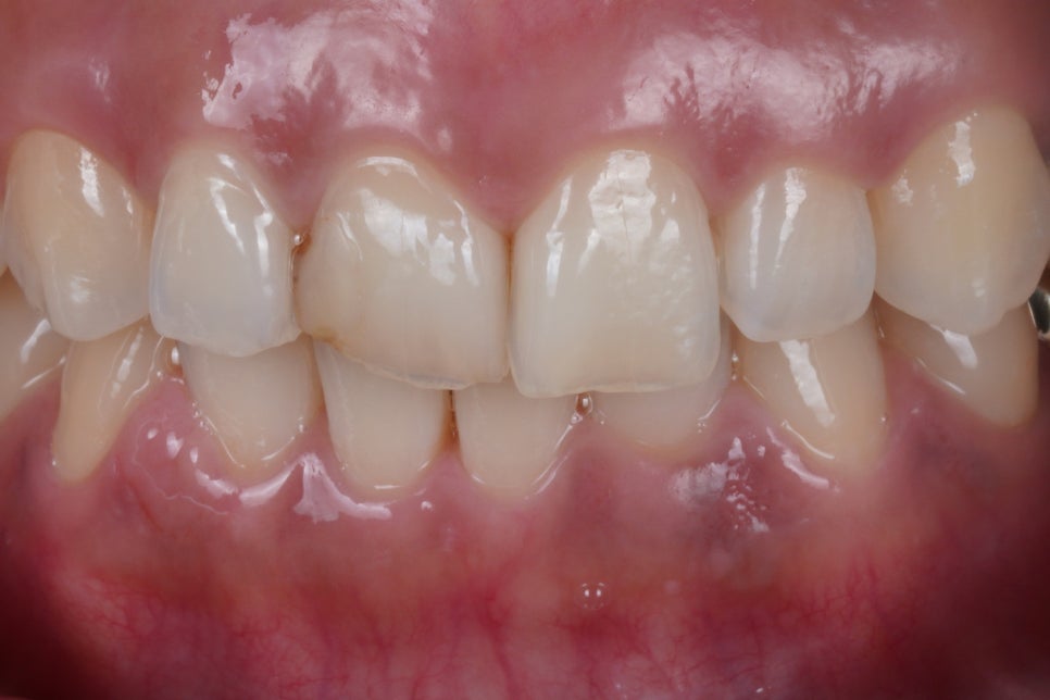 앞니 레진이 깨졌을 때, 재치료 잘하는 서초 치과 관련 이미지 1