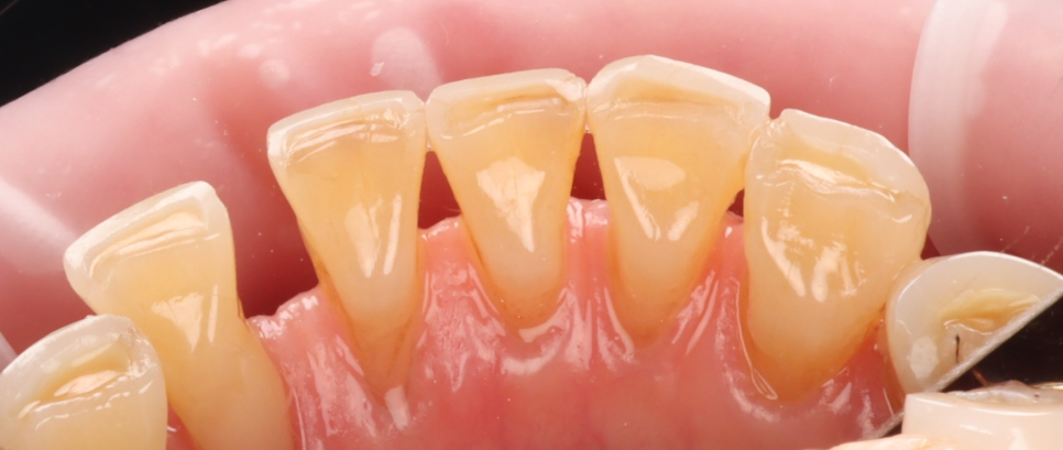 반포치과 70대 앞니 벌어짐 레진 당일 치료 케이스 관련 이미지 6