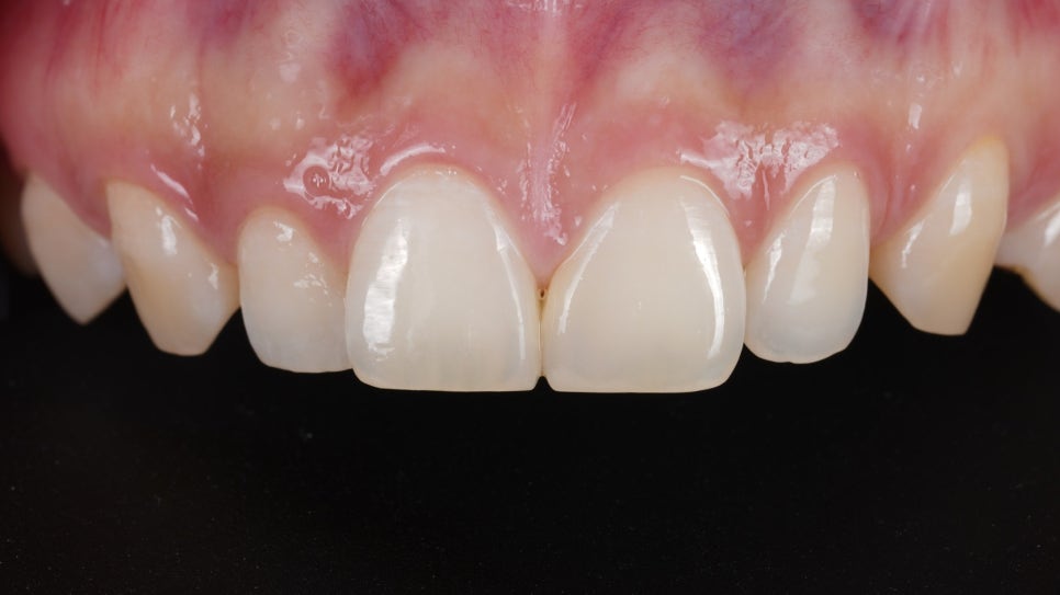 블랙트라이앵글 자연스럽게 메우는 비결은 이것 관련 이미지 12