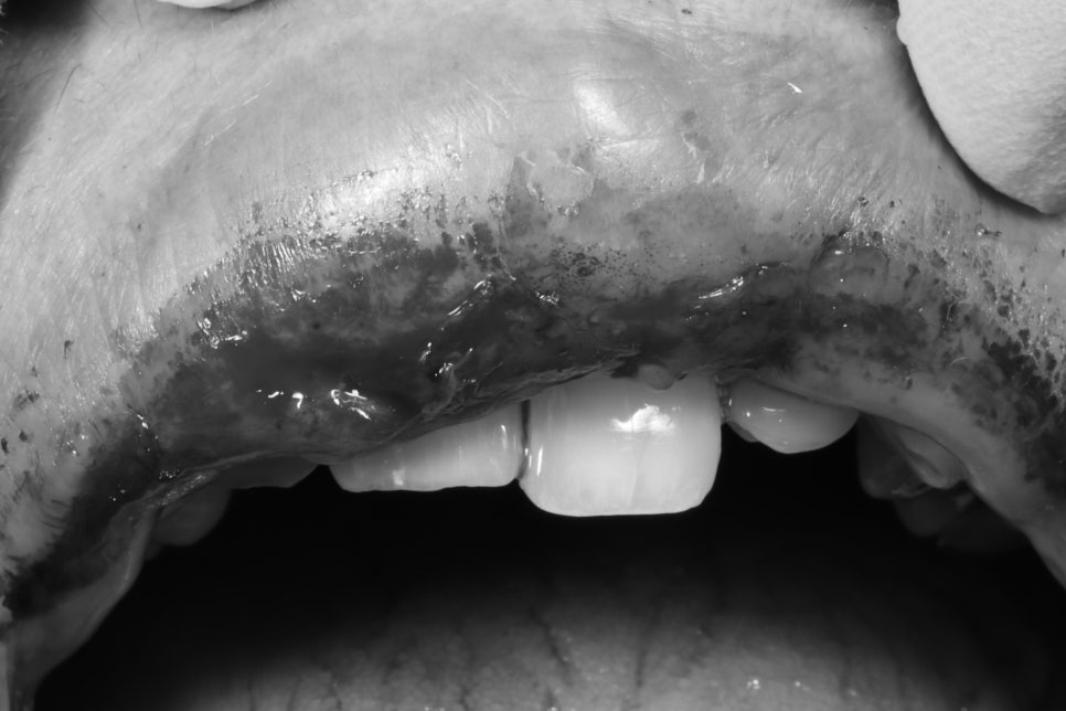 넘어져서 빠질 뻔한 앞니를 신경치료해 지르코니아 크라운으로 살린 케이스 관련 이미지 2