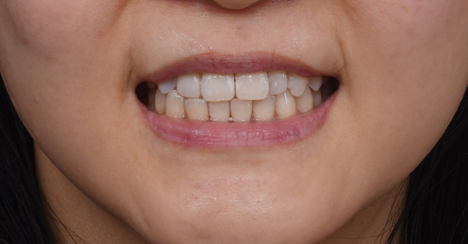 왜소치레진 20년 전에 했던 치아 재치료 후 반대쪽까지 관련 이미지 14