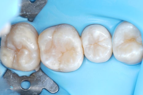 교대역 충치, 신경치료 회피하는 레진빌드업 치과이야기 관련 이미지 4