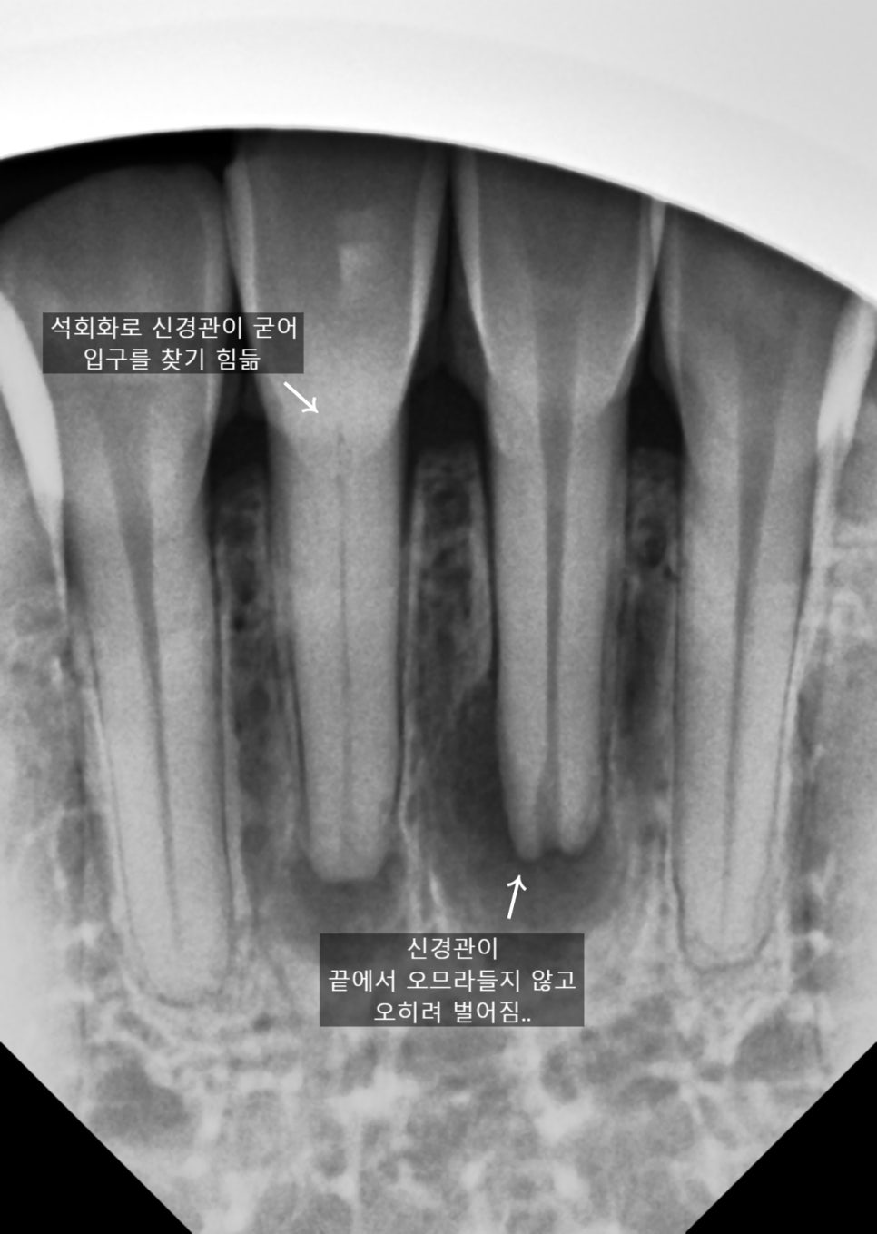 교대역 앞니 신경치료 후 지르코니아 크라운 치과 관련 이미지 2