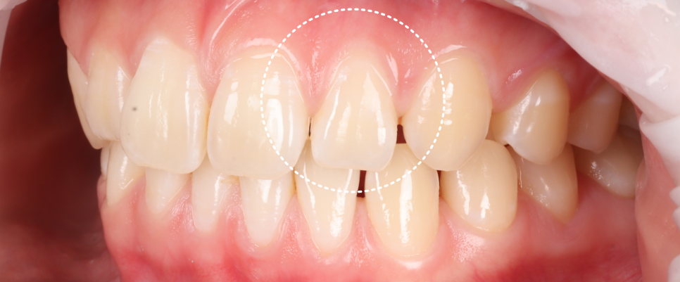 역삼역치과 벌어진 앞니 레진 이렇게 해야 진짜 티 안나요 관련 이미지 11