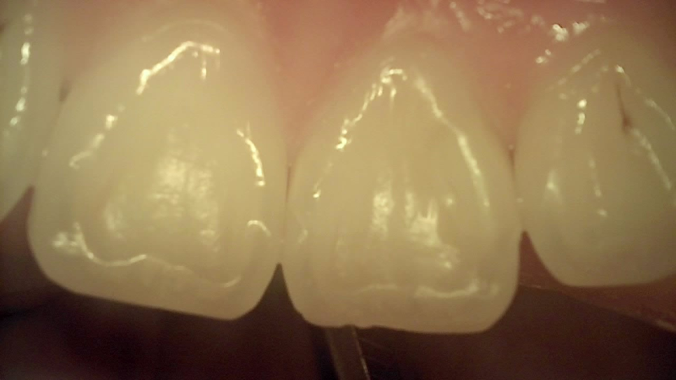 교대역치과 타치과 신경치료, 크라운 진단받았으나 레진으로 치료 관련 이미지 11