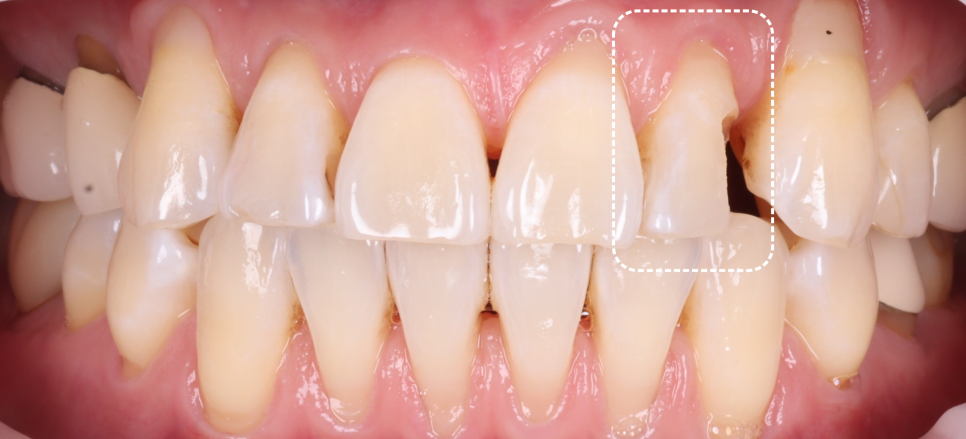 서초구치과 레진 탈락 재치료 2가지가 성공 핵심입니다 관련 이미지 3