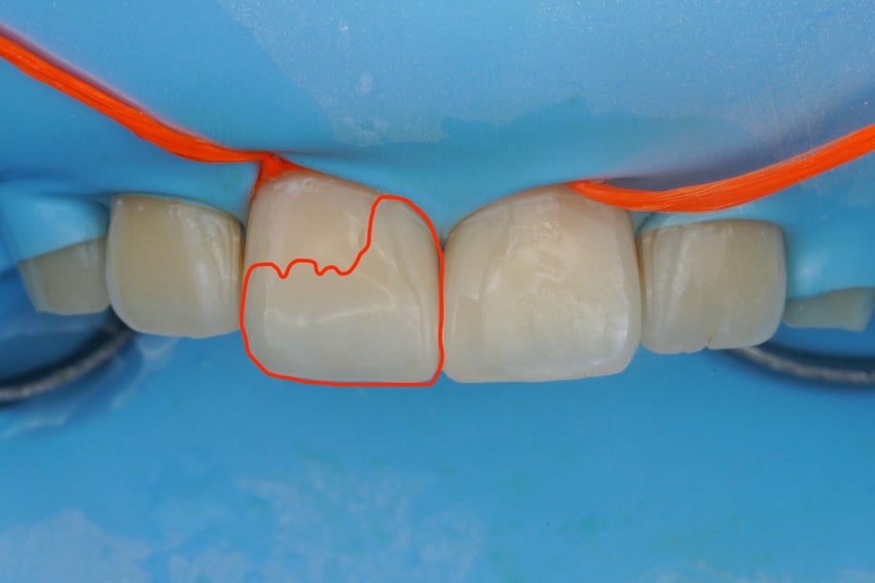 앞니 벌어짐을 레진 비니어로 당일 치료한 서초동 치과 관련 이미지 8